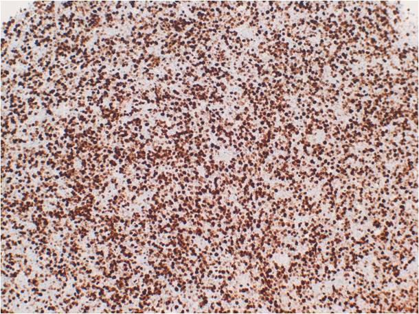 Figure 9b. Right ethmoid sinus, Ki-67 of 70-80%, 10x